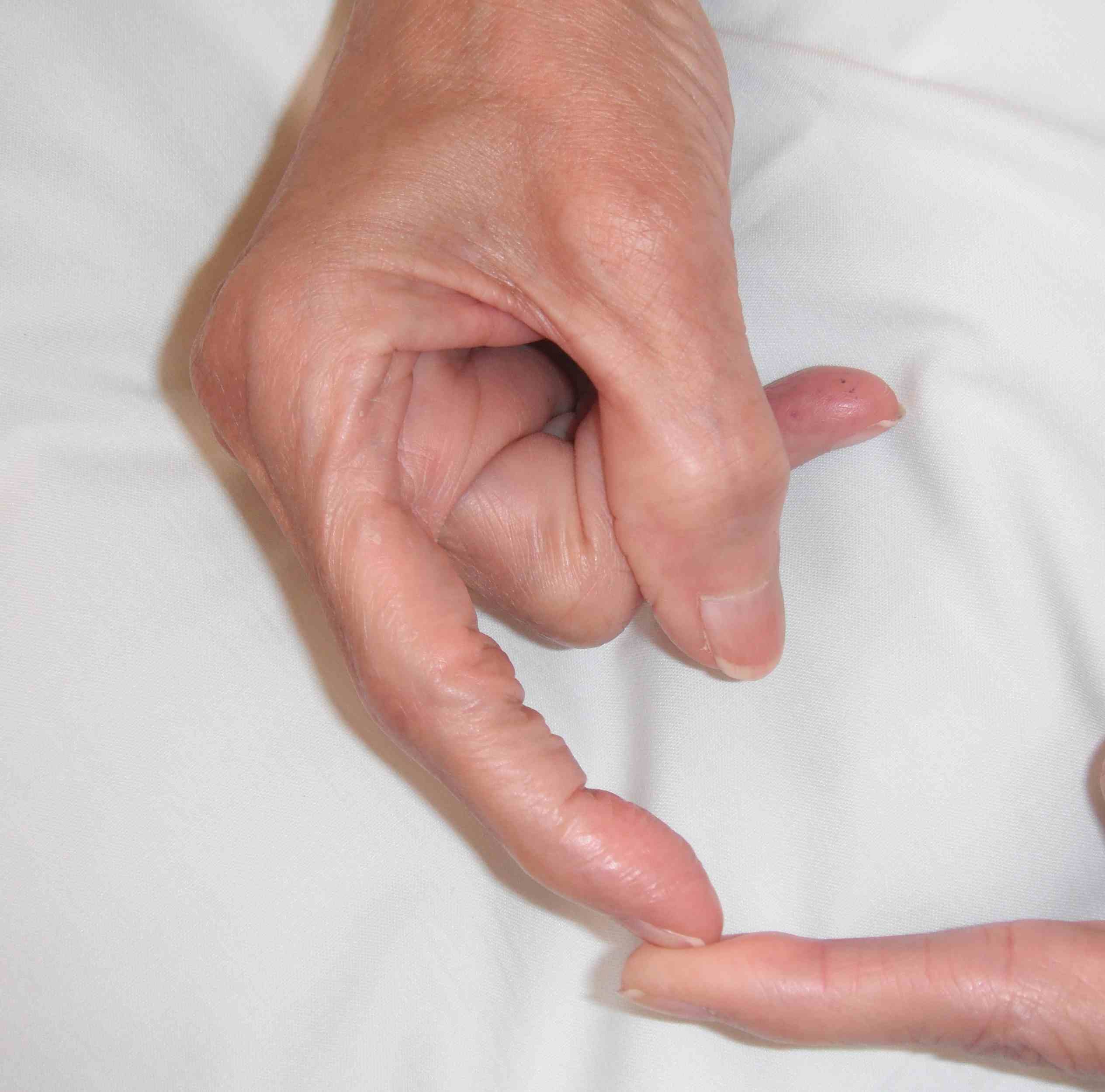 Rheumatoid Swan Neck Finger 1